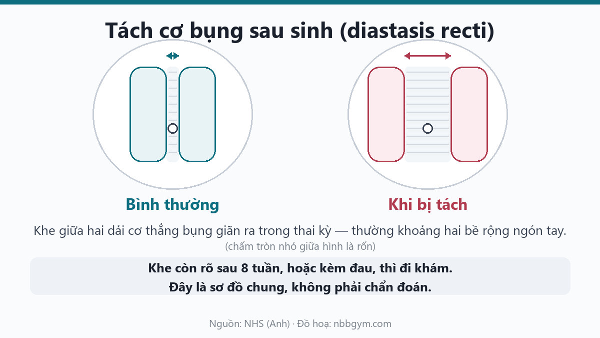 Sơ đồ tách cơ bụng sau sinh: khe giữa hai dải cơ thẳng bụng khi bình thường và khi bị tách
